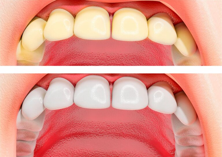 Teeth Whitening Before and After